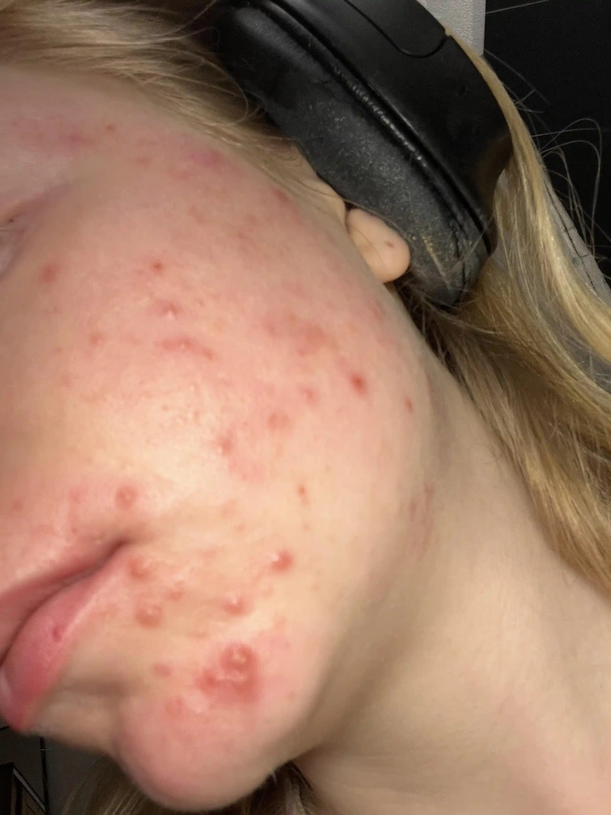 Sivilce Sıkmayı Bırakmanın Etkili Yöntemleri ve Cilt Sağlığına Katkıları