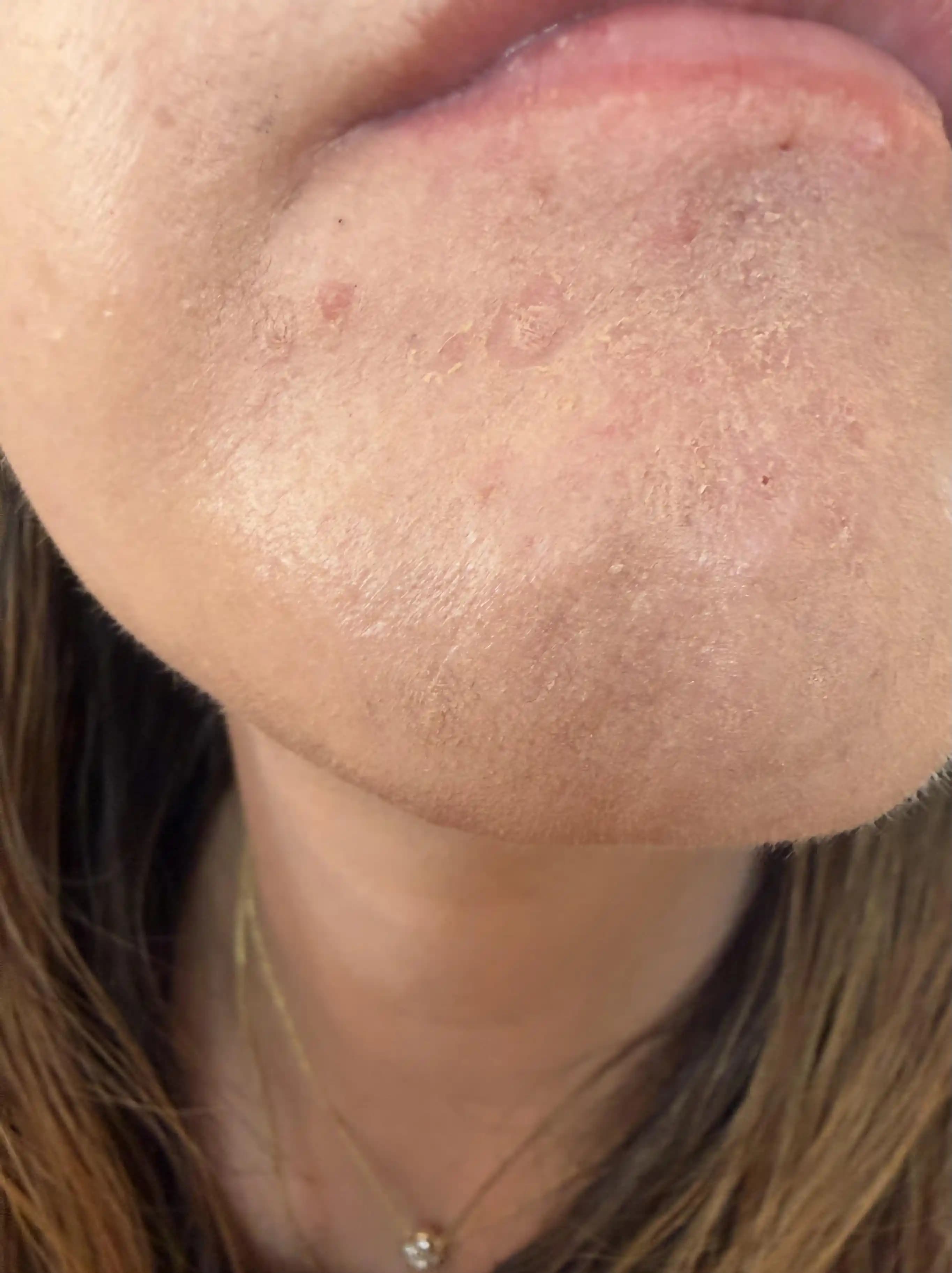 Tretinoin Kullananlarda Fondötenin Kuruyup Pul Pul Olmasının Nedenleri ve Çözüm Yolları