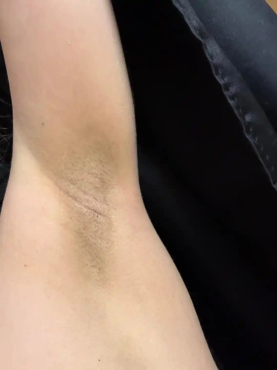 Koyu Bikini Bölgesi ve Koltuk Altı Cilt Tonu: Nedenleri, Tedavi Yöntemleri ve Uzman Görüşleri