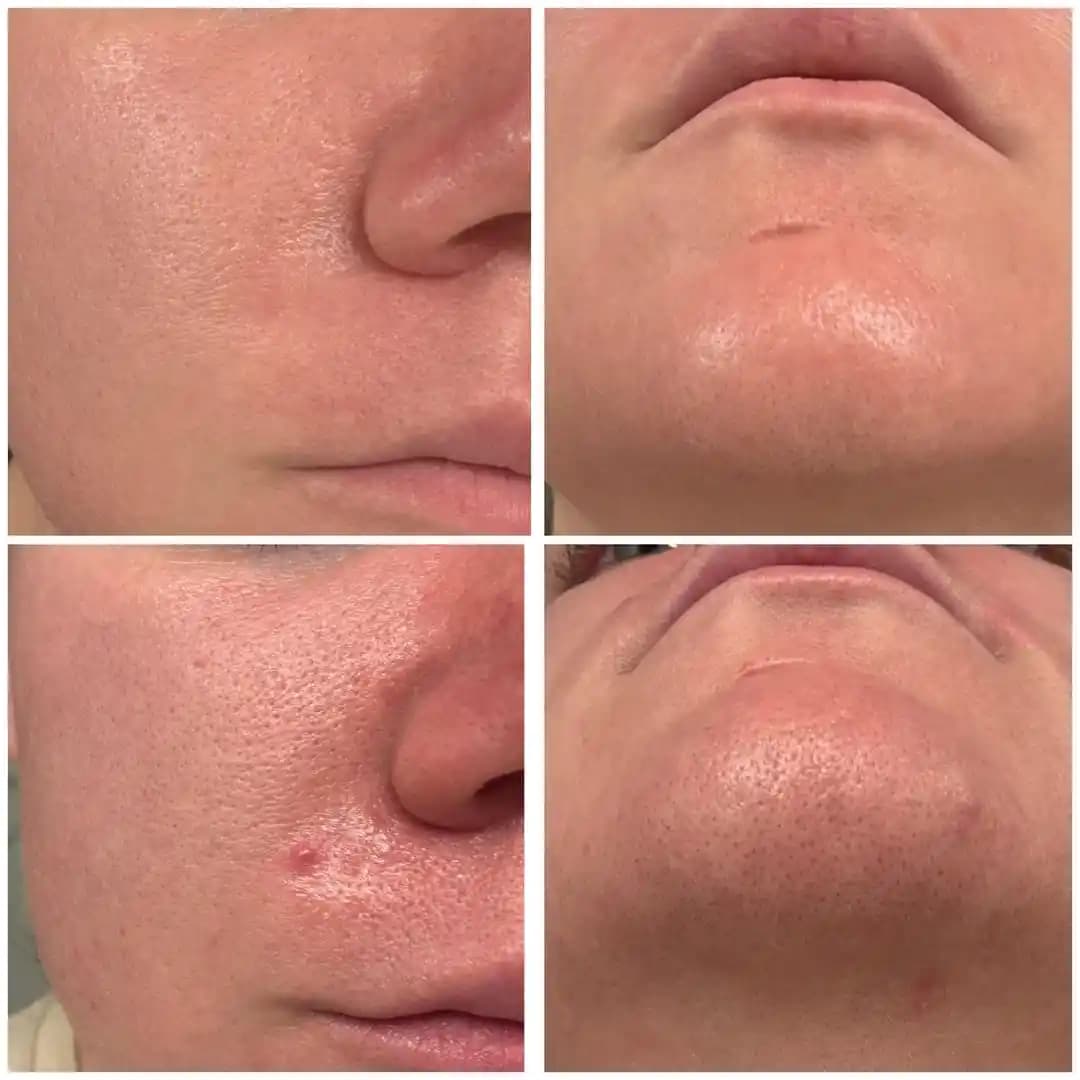 Rosacealı Hassas Ciltler İçin 2 Haftalık Kore Cilt Bakım Rutini ve Yapay Zeka Destekli Ürün Seçimi