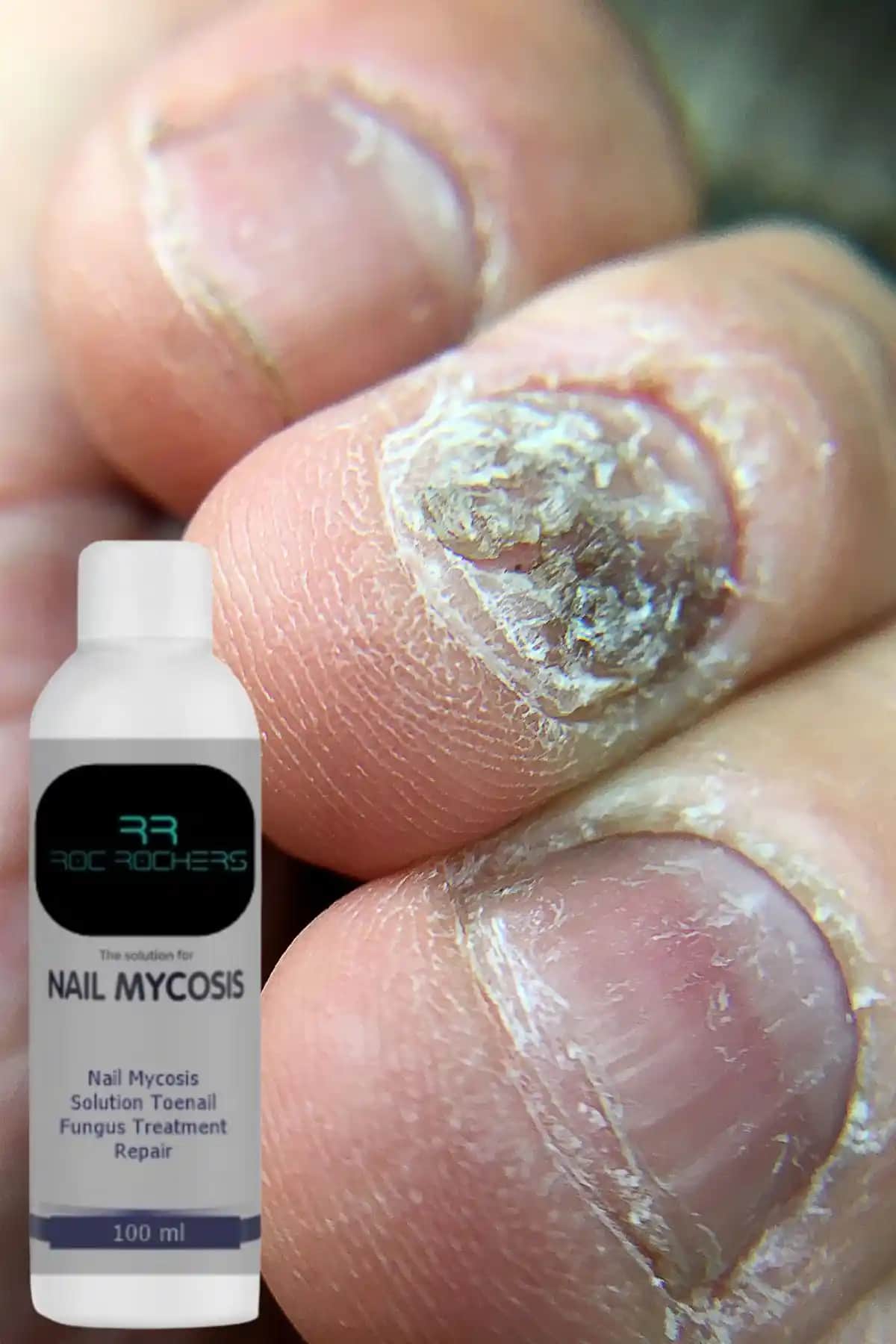 Roc Rochers Doğal İçeriğiyle Tırnak Mantarı ve Sağlığına Destek Sağlayan Ürün