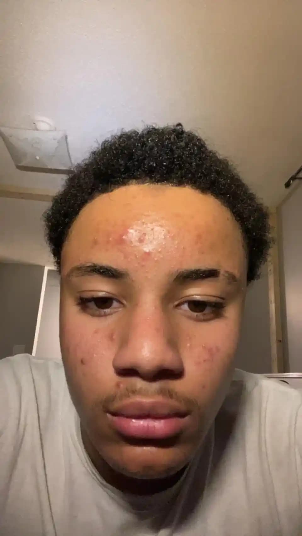 Akne Tedavisinde Etkili Yöntemler, Ürün Kullanımı ve Dikkat Edilmesi Gerekenler