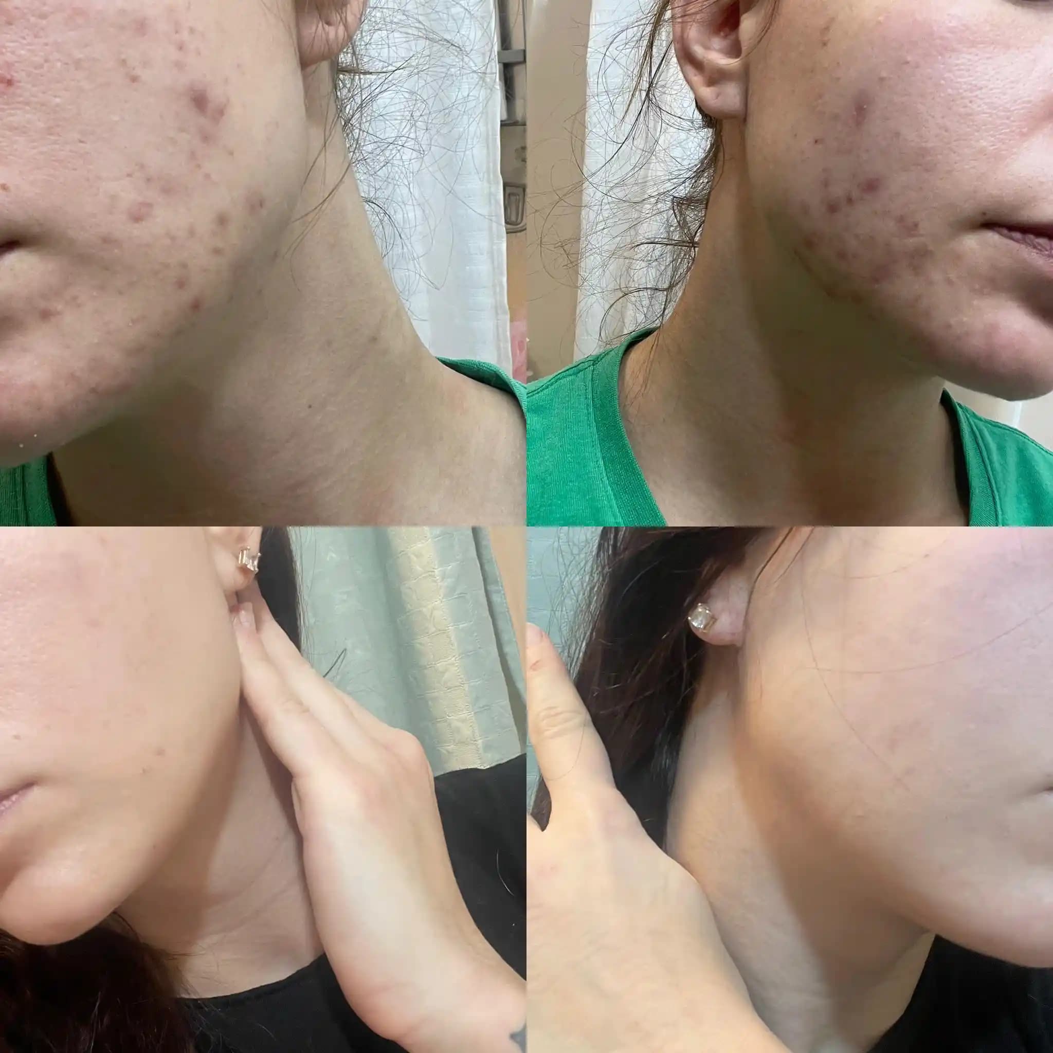 Akne Tedavisinde Filtrelenmiş Su ve Spearmint Çayının Rolü ve Basit Cilt Bakımı Yaklaşımları