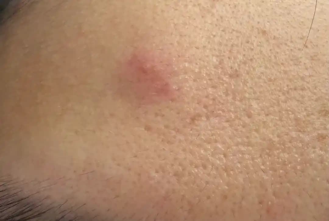 Alında Aynı Noktada Tekrarlayan Sivilce Nedenleri ve Etkili Tedavi Yöntemleri