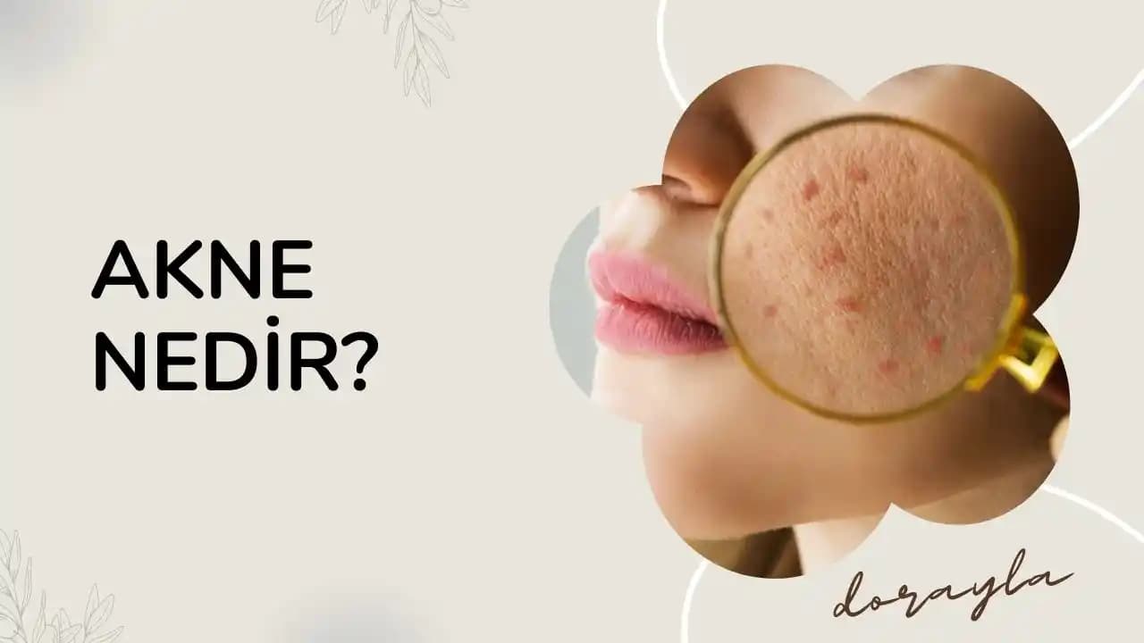 Beslenme ve Akne İlişkisi: Süt Ürünleri, Şeker, Kafein ve Cilt Sağlığı Üzerindeki Etkileri