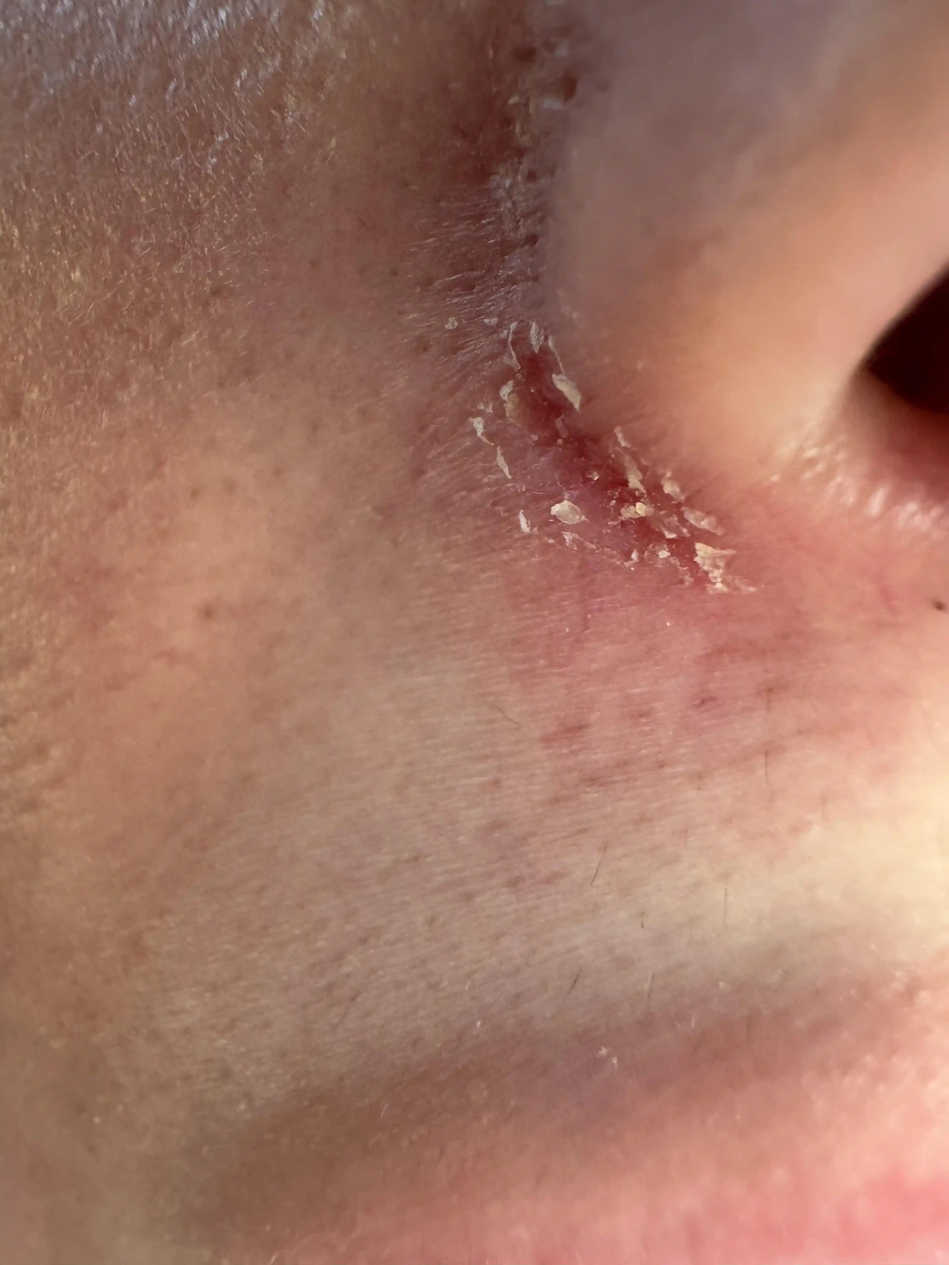 Burun Kenarındaki Kırışıklık ve Deri Sorunları: Nedenleri, Belirtileri ve Etkili Tedavi Yöntemleri