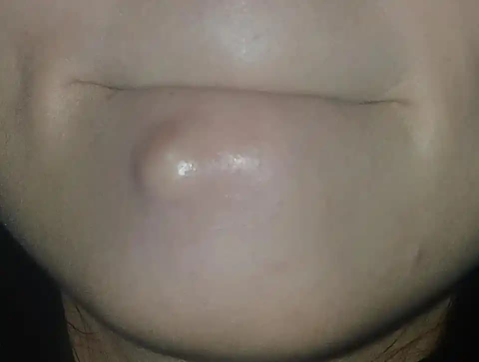 Büyük Çene Kisti: Tanımı, Tedavi Yöntemleri ve Uzman Görüşleri Üzerine Kapsamlı İnceleme