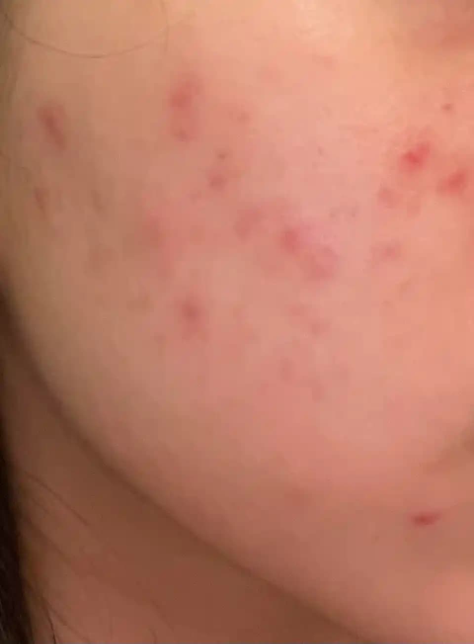 Doksisiklin ile Kistik Akne Tedavisi: Etkiler, Yan Etkiler ve Kullanıcı Deneyimleri