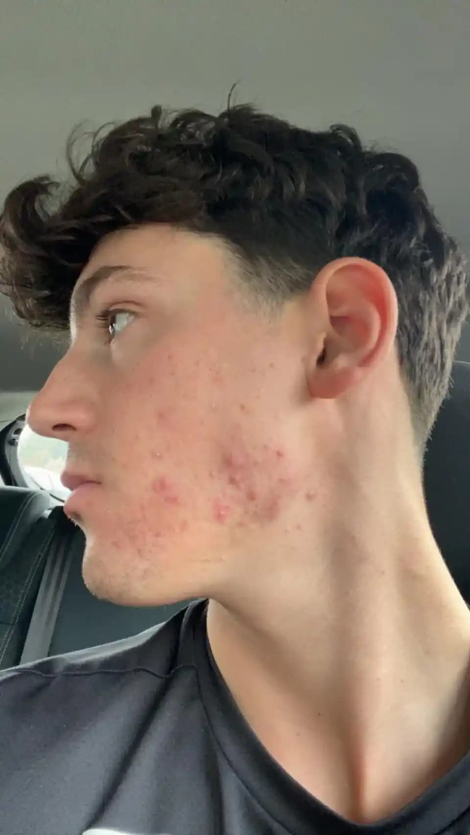 Duac Kullanımı ve Ciltte İlk Aşamada Görülen Kötüleşme: Nedenleri ve Yönetimi