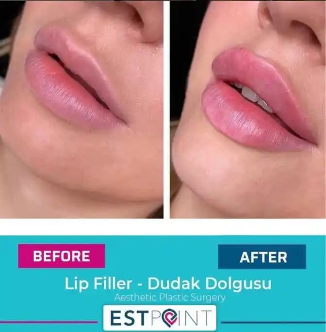 Dudak Dolgusu Sonrası Doğal Görünüm ve İyileşme Süreci Değerlendirmesi