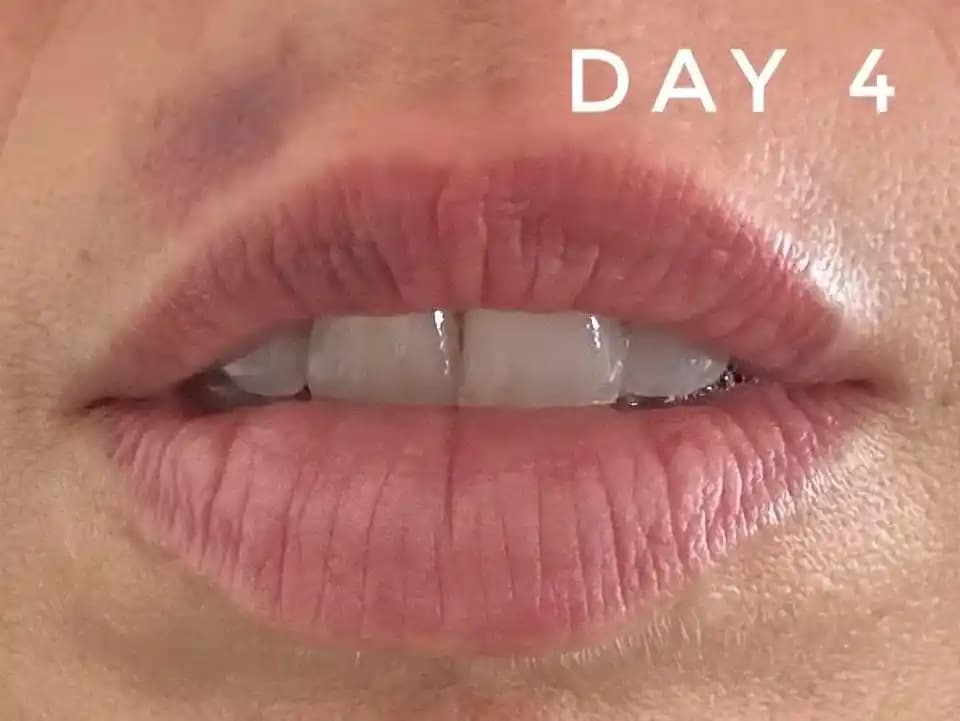 Dudak Dolgusu Sonrası Şişlik ve Morarma: İyileşme Süreci ve Dikkat Edilmesi Gerekenler