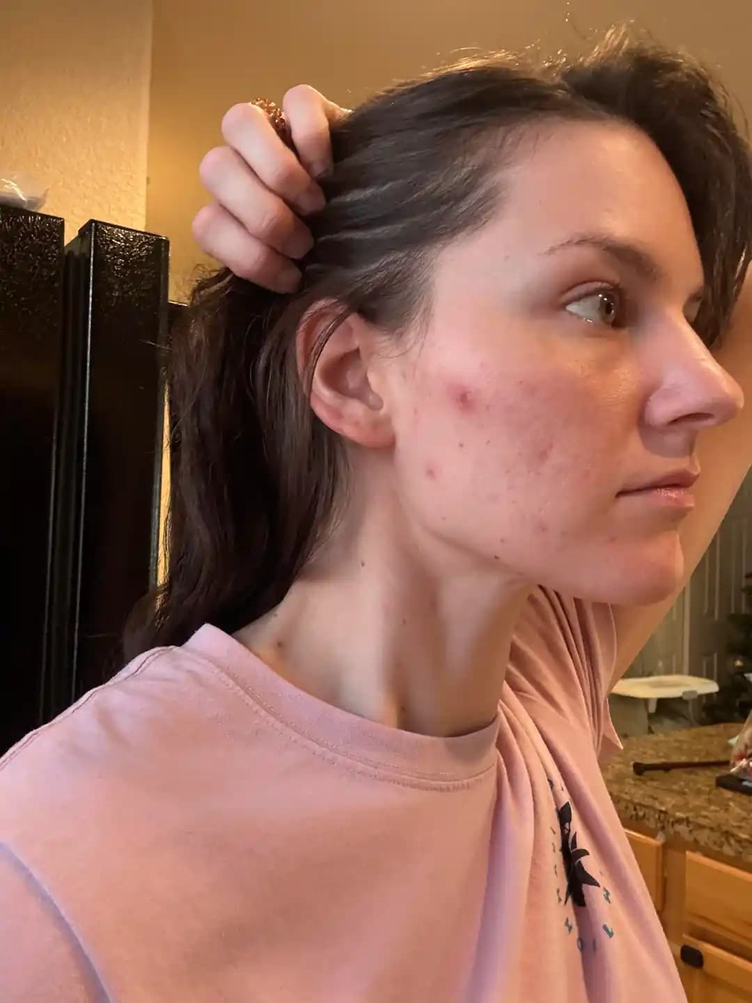 Hormonal Akne Tedavisinde Spironolakton ve Uzun Süreli Cilt Bakımı Yaklaşımları