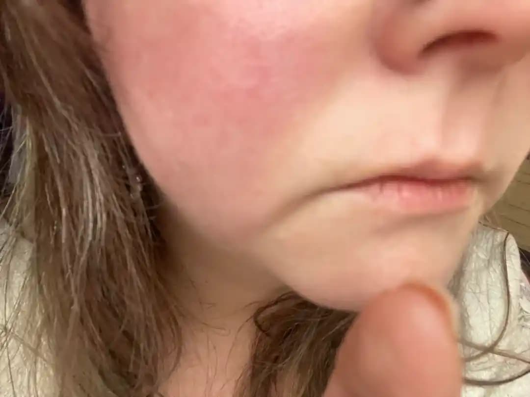 Marionette Çizgileri İçin Botox ve Cilt Bakımıyla Etkili Tedavi Yöntemleri