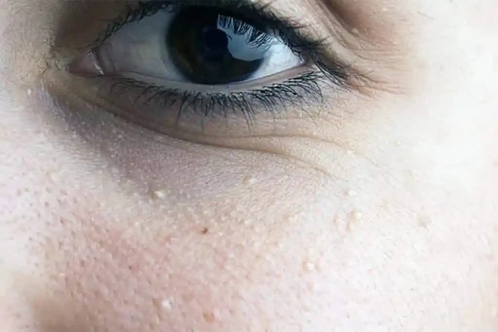 Milia Nedir ve Nasıl Tedavi Edilir? Etkili Yöntemler ve Kullanıcı Deneyimleri