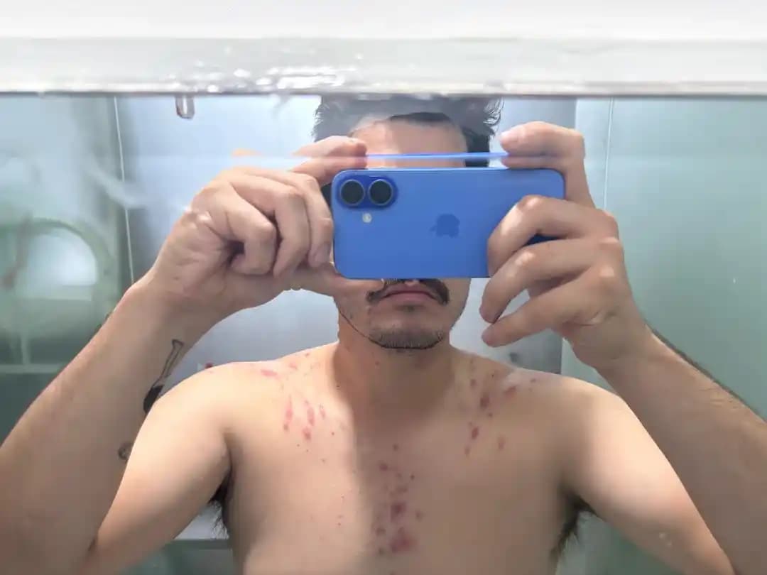 Şiddetli Akne Tedavisi: Dermatolog Görüşleri ve İlaç Kullanımının Önemi