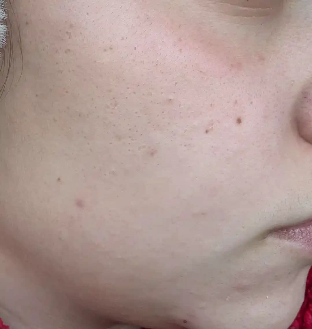 Sivilceye Neden Olan Nemlendiriciler ve Cilt Bakımında Doğru Ürün Seçimi Rehberi