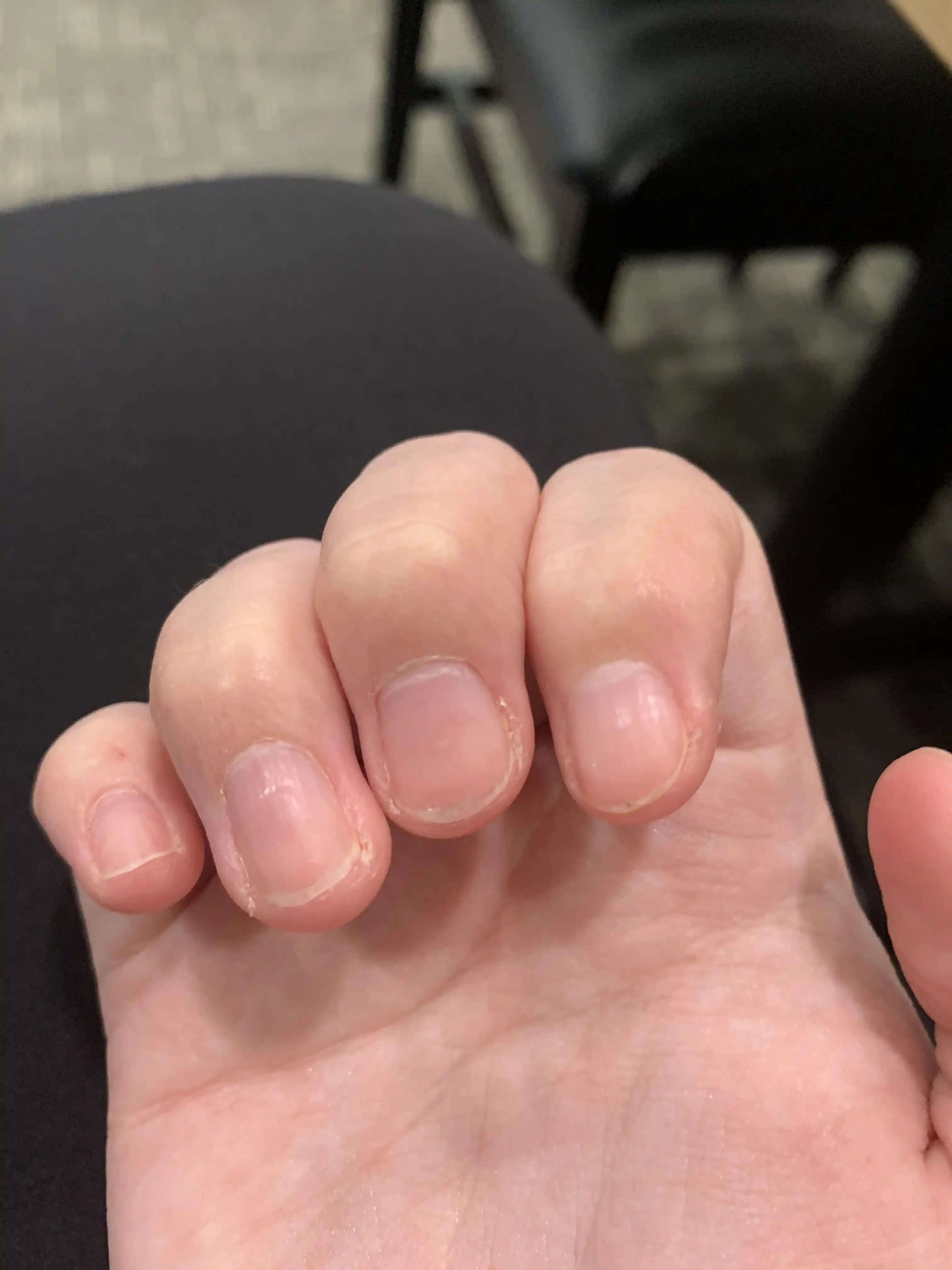 Tırnak Etrafındaki Derinin Bakımı: Kuruluk ve Ölü Deri Sorunlarına Etkili Çözümler