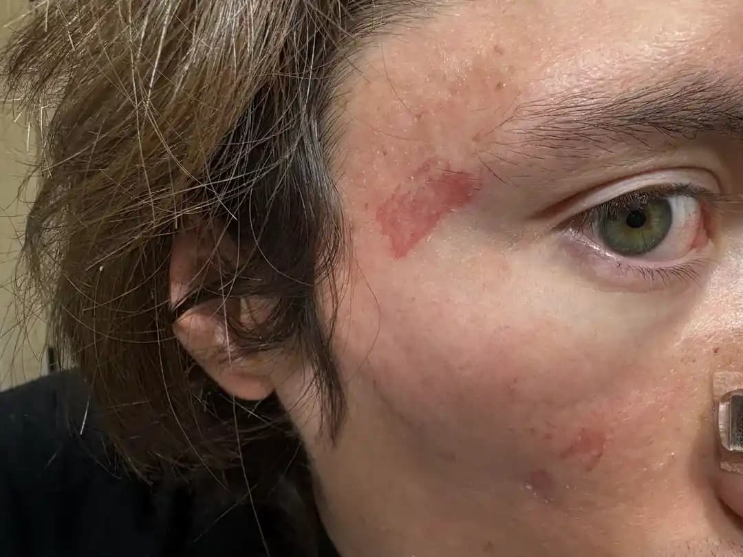 Uyku Çalışması Sonrası Deri Soyulması ve İz Kalmasını Önlemek İçin Etkili Yara Bakımı Yöntemleri