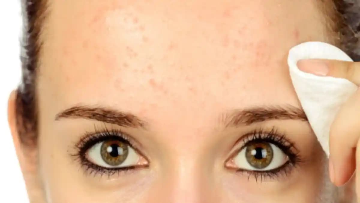 Alındaki Sivilcelerin Nedenleri ve Etkili Bakım Yöntemleri Üzerine Kapsamlı İnceleme