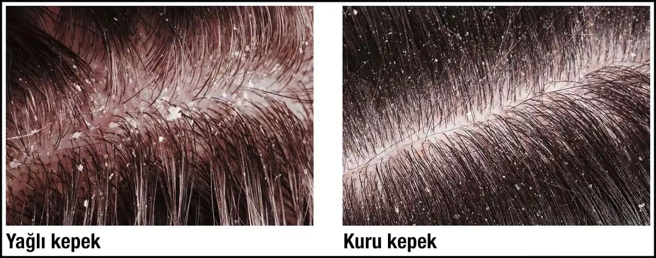Aşırı Kepek Nedenleri, Belirtileri ve Saç Derisi Sağlığı İçin Etkili Çözümler