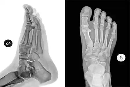 Ayak Tarak Kemiği Kırığı: Belirtileri, Tedavisi ve Kişisel Bakım Önerileri