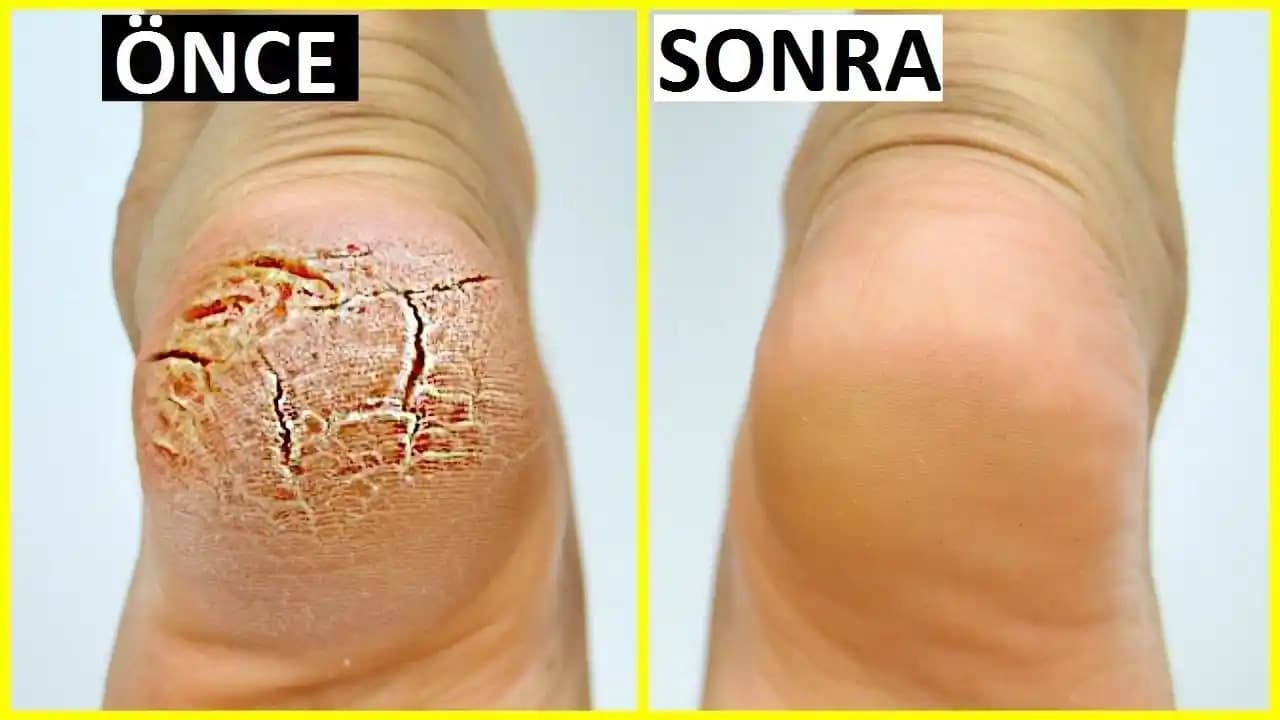 Ayak Topuğu Çatlağına Ne İyi Gelir? Etkili Doğal ve Medikal Çözümler