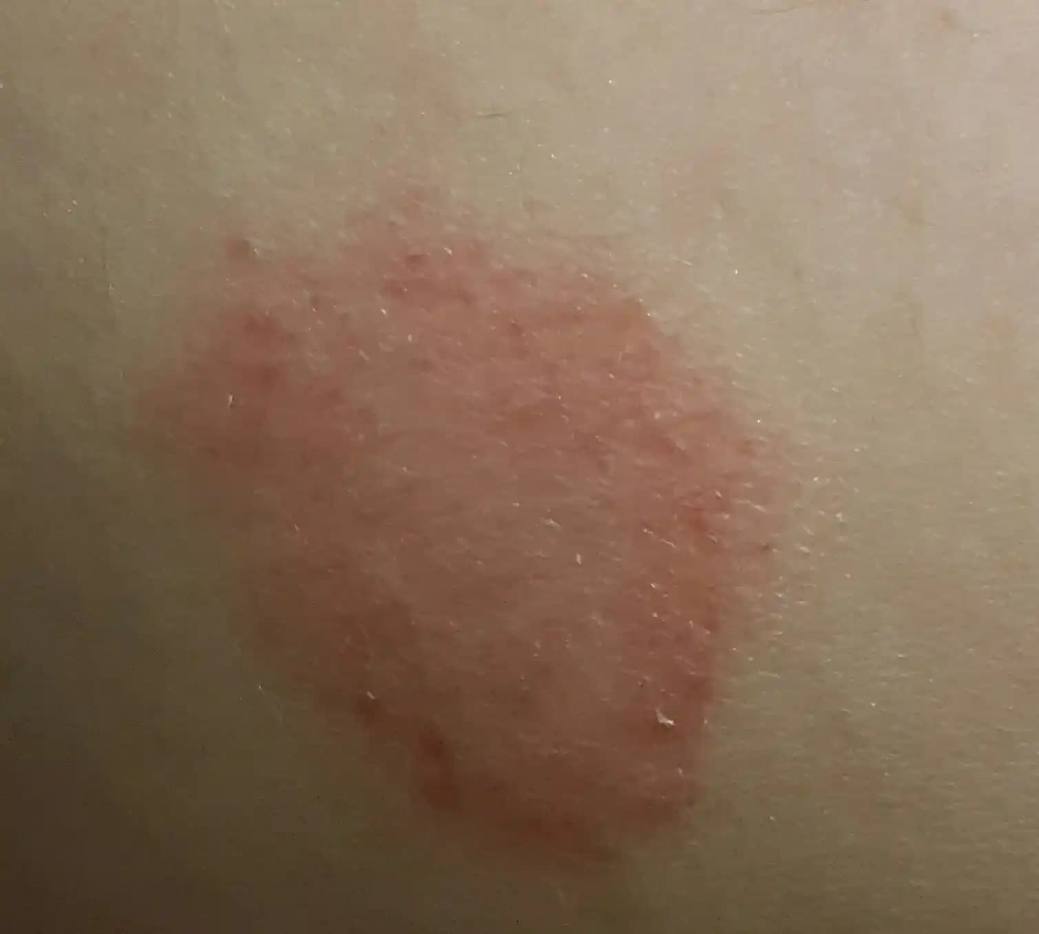 Bacağınızda Kırmızı Leke Nedenleri, Bakımı ve Etkili Çözüm Yöntemleri