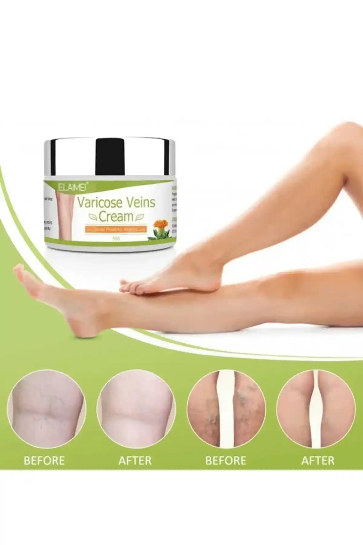 Bacak Varis Kremi: Varis Belirtilerini Azaltan ve Damar Sağlığını Destekleyen Etkili Çözüm