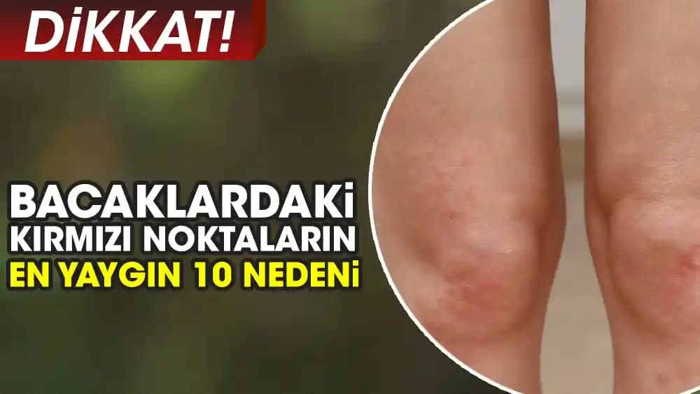Bacakta Kırmızı Lekeler: Nedenleri, Teşhis Yöntemleri ve Etkili Tedavi Seçenekleri