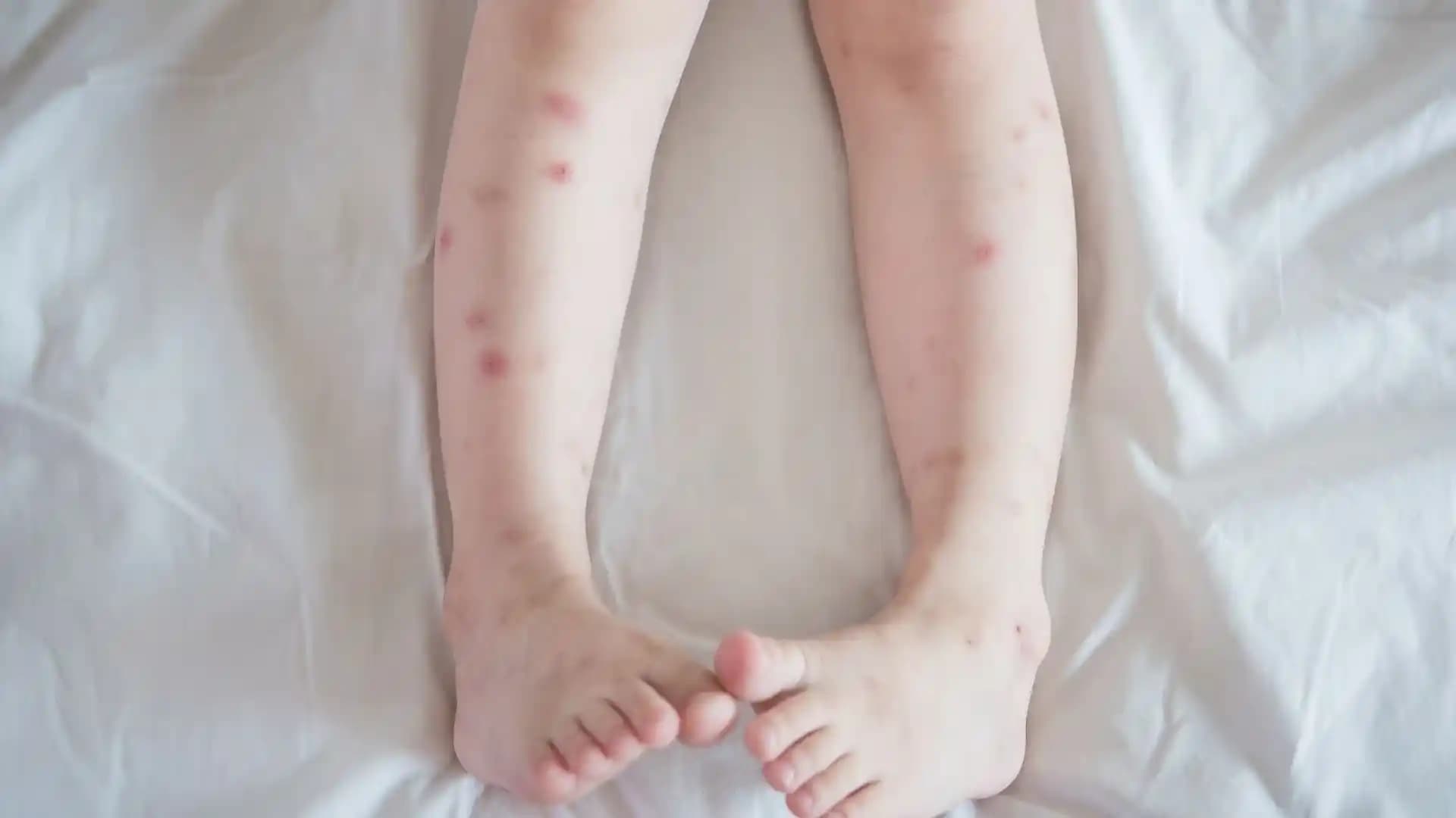 Bacakta Leke Nedenleri, Tedavi Yöntemleri ve Etkili Bakım Önerileri