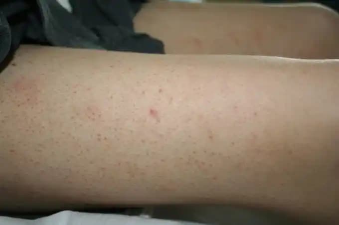 Bacakta Lekeler: Nedenleri, Tedavi Yöntemleri ve Etkili Korunma İpuçları