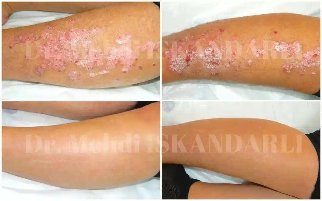 Baldırda Yara Çıkması: Nedenleri, Belirtileri, Önlenmesi ve Etkili Tedavi Yöntemleri