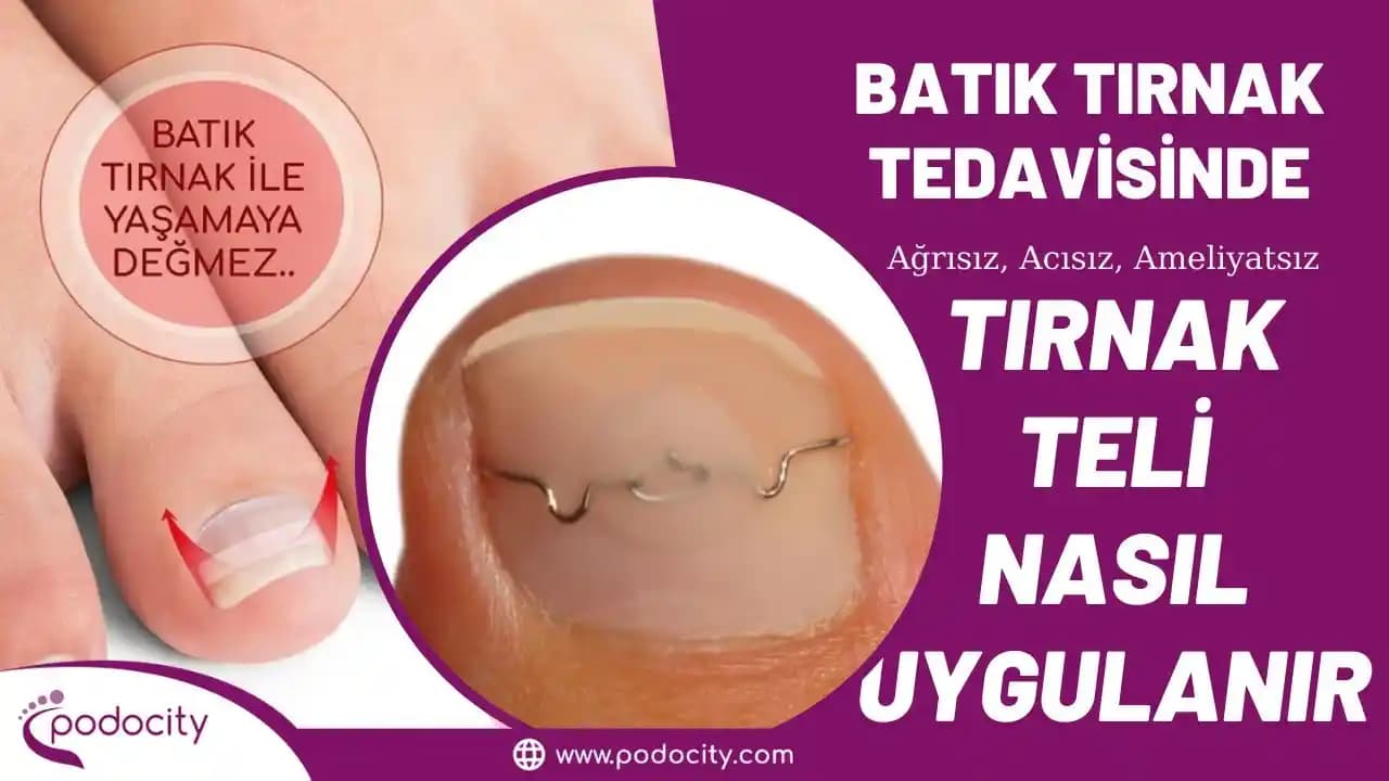 Batık Tırnak Teli ile Batık Tırnak Sorununa Etkili ve Estetik Tedavi Yöntemi