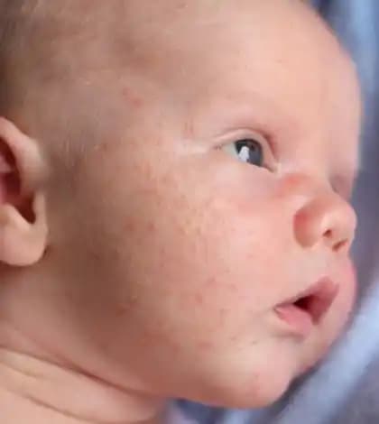 Bebek Aknesi: Yenidoğanlarda Görülen Cilt Problemi ve Bakım Yöntemleri