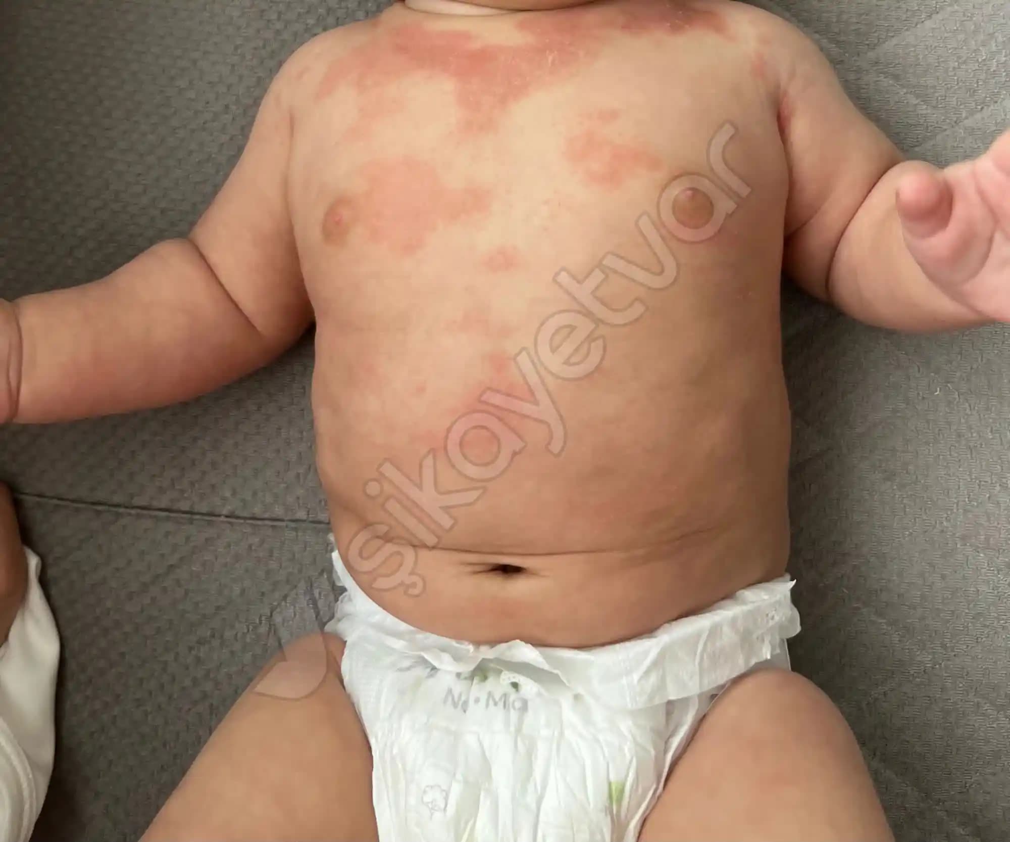 Bebek Yağı Alerji Yapar mı? Bebek Cilt Bakımında Güvenli Ürün Seçimi Rehberi