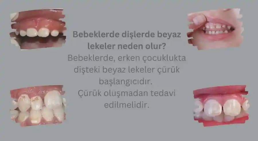 Bebeklerde Beyaz Leke Nedenleri, Tedavisi ve Doğru Cilt Bakımı Önerileri