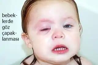 Bebeklerde Göz Kapağı Morarması: Nedenleri, Belirtileri ve Etkili Bakım Yöntemleri