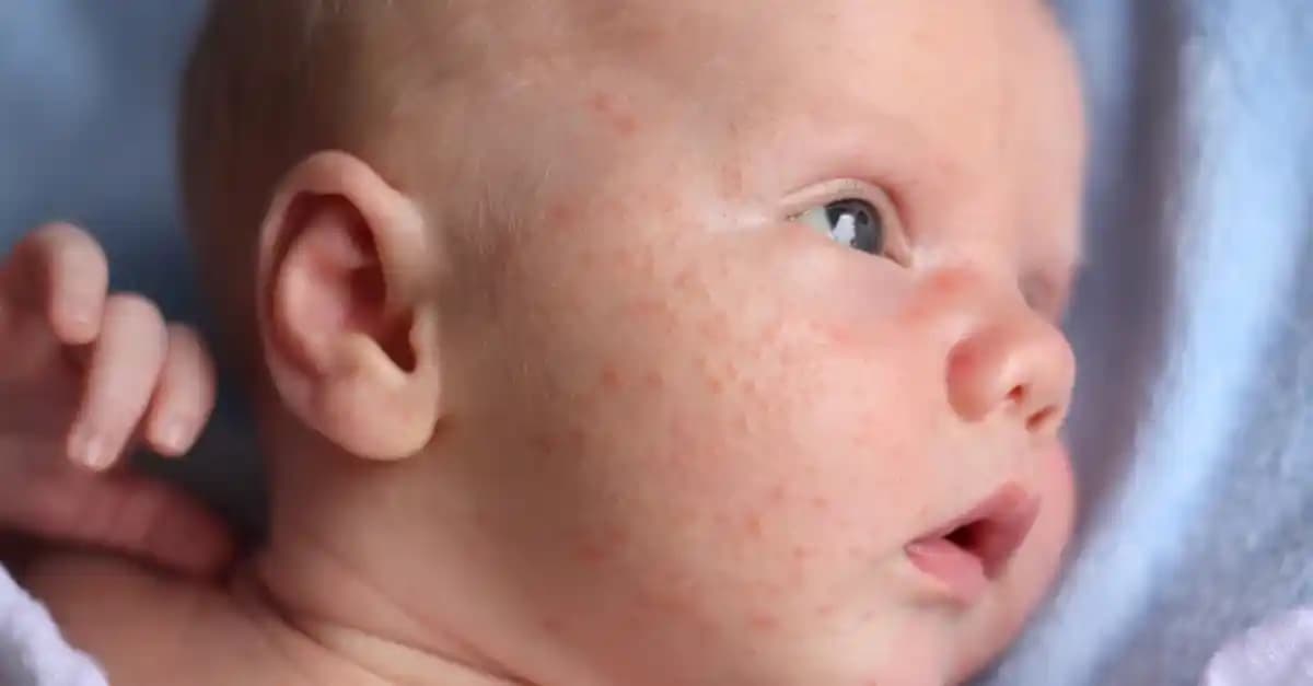 Bebeklerde Sivilce Nedenleri, Türleri ve Etkili Bakım Yöntemleri