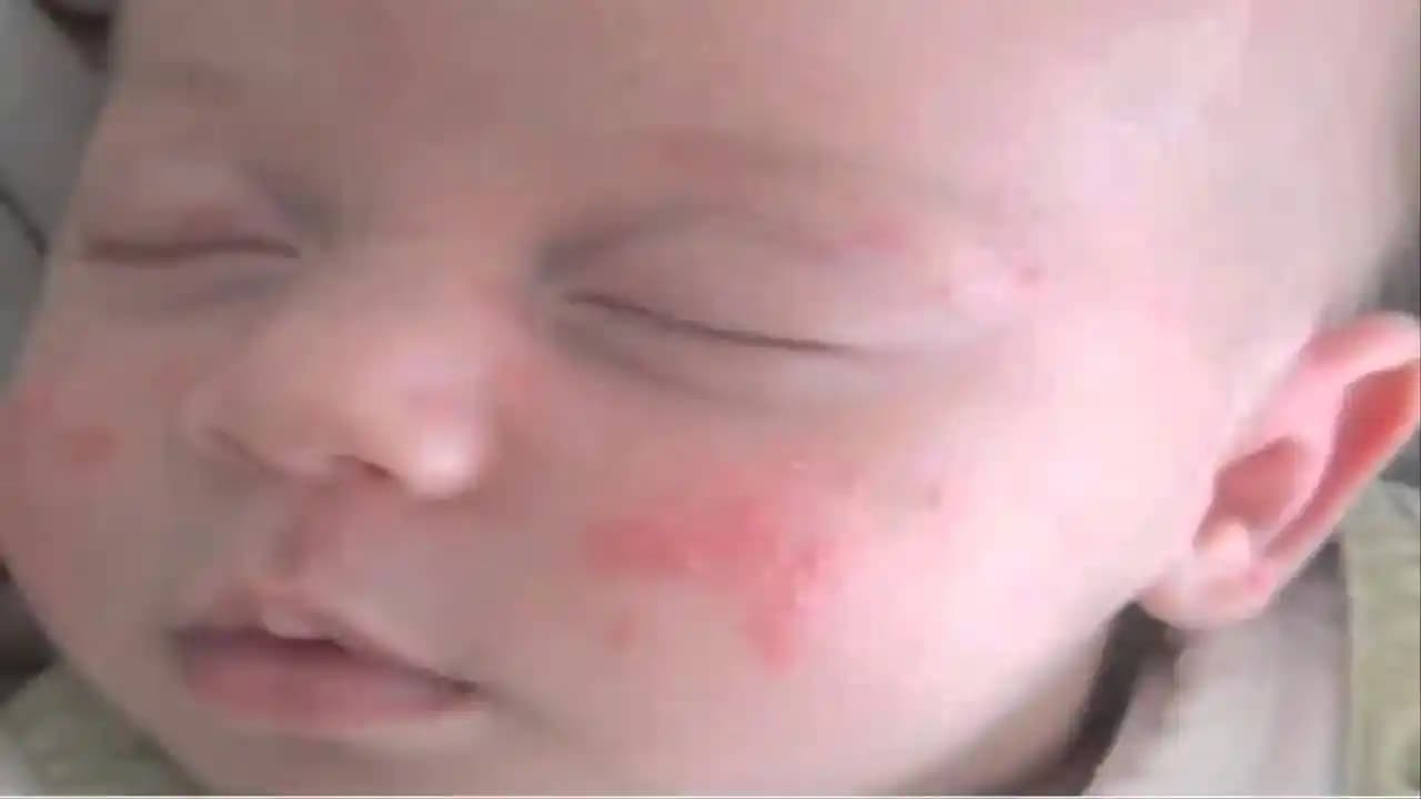 Bebeklerde Yüz Kızarıklığı: Nedenleri, Bakımı ve Doğru Ürün Seçimi Rehberi