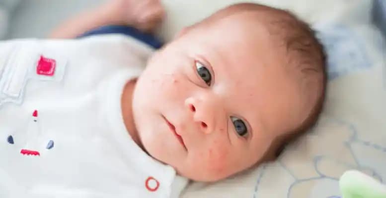 Bebeklerde Yüzde Kızarıklık Nedenleri, Önlemleri ve Doğal Çözüm Yöntemleri