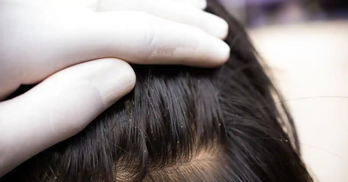 Bit Renkleri ve Saç Sağlığı: Güzellik ve Kişisel Bakımda Bitlerin Anlamı ve Önemi