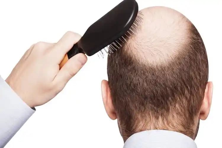 Bit Saç Döker Mi? Bitlerin Saç Sağlığı Üzerindeki Etkileri ve Tedavi Yöntemleri