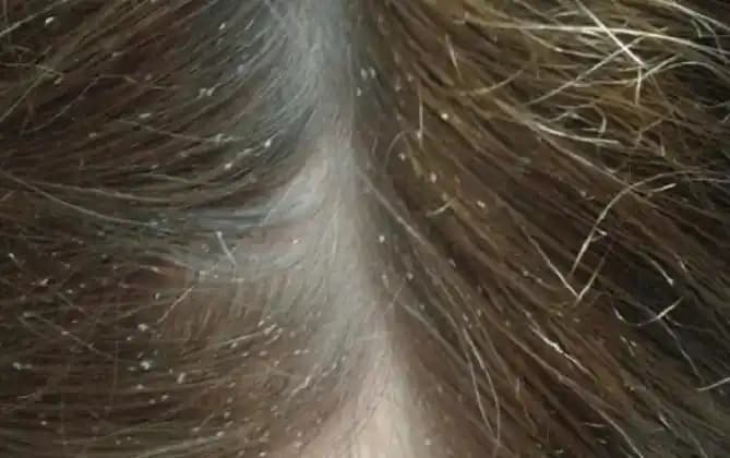 Bit Saçta Nasıl Görünür? Detaylı Rehber ve Etkili Korunma Yöntemleri