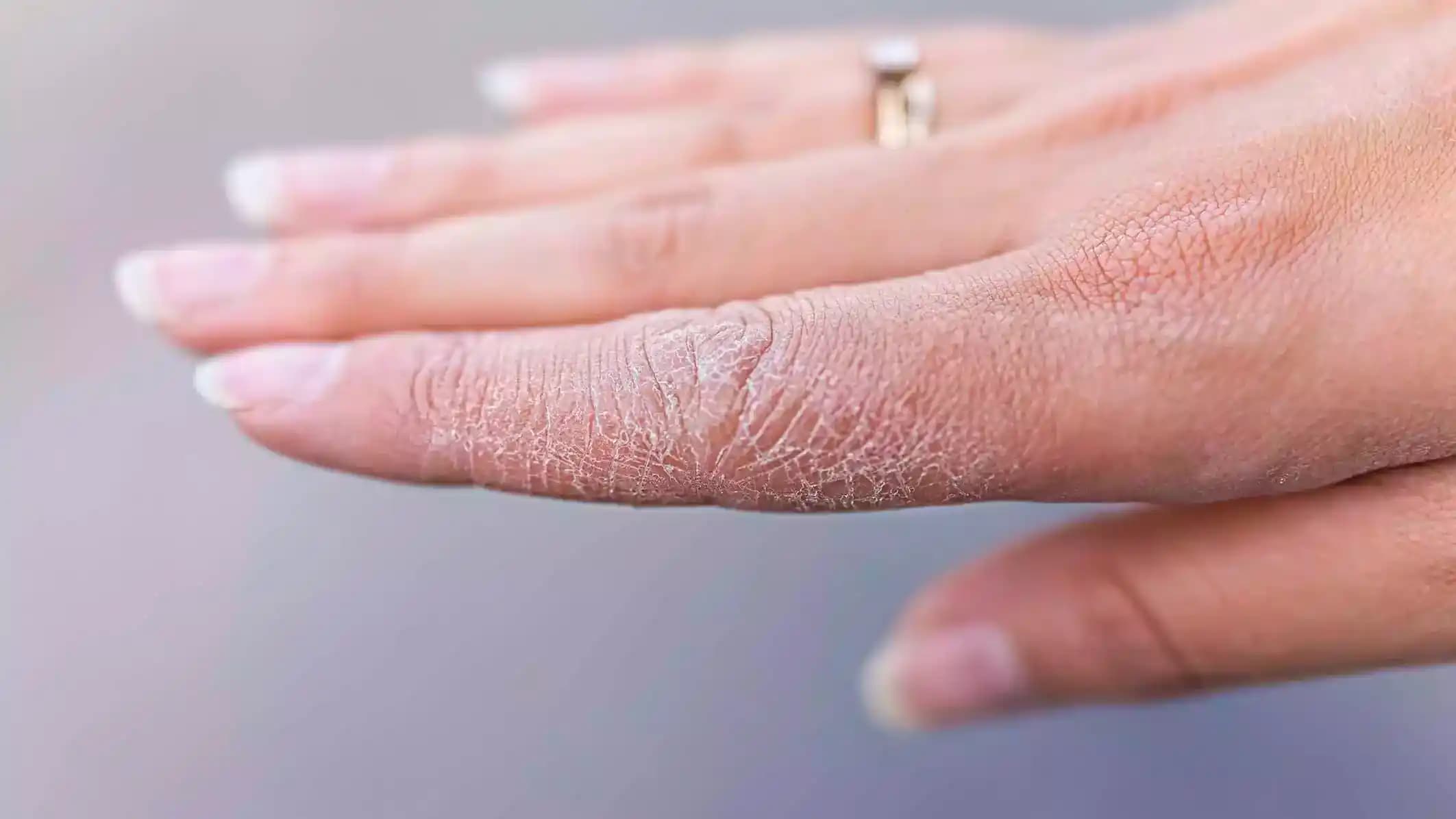 Çatlak El Bakımı: Sağlıklı ve Pürüzsüz Eller İçin Etkili Yöntemler ve Öneriler