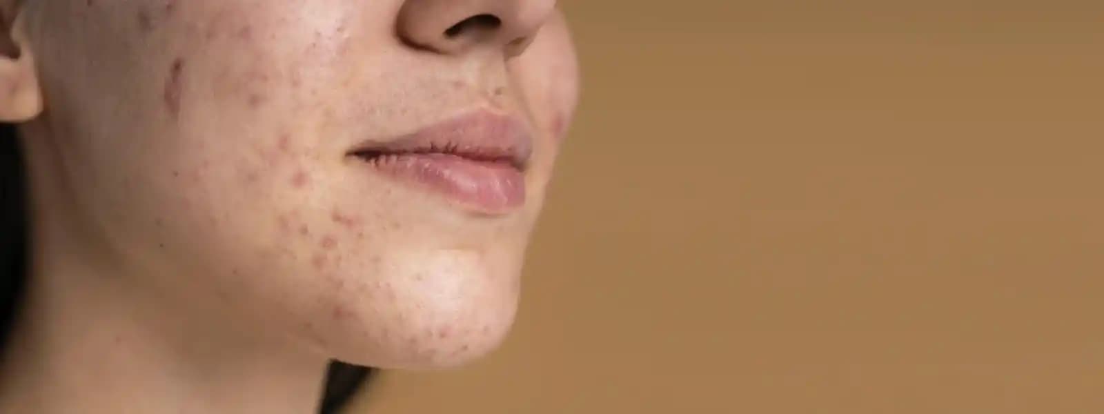 Çene Altında Çıkan Sivilceler: Nedenleri, Önleme ve Etkili Tedavi Yöntemleri