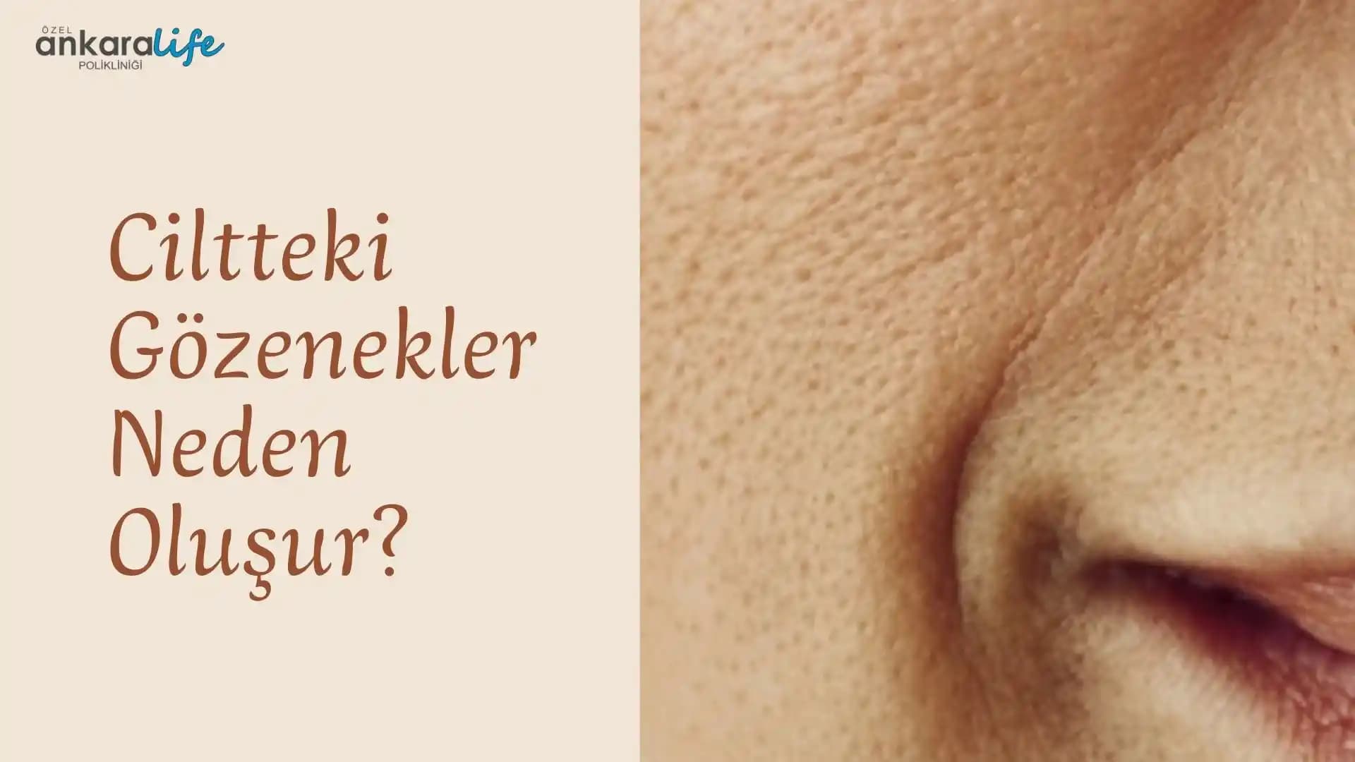 Cilt Gözeneklerinin Nedenleri ve Görünümünü İyileştirme Yöntemleri Hakkında Bilgi