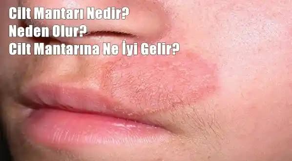 Cilt Mantarı İçin Etkili Doğal ve Modern Tedavi Yöntemleri: Korunma ve Bakım