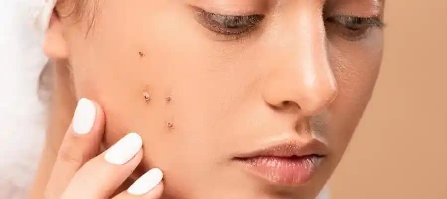 Ciltte Komedon Nedir? Türleri, Nedenleri ve Etkili Tedavi Yöntemleri