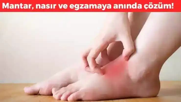 Ciltte Mantara İyi Gelen Etkili Tedavi ve Korunma Yöntemleri Rehberi