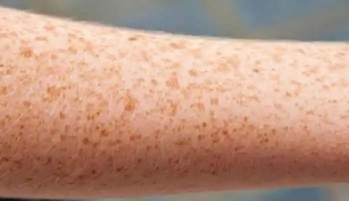 Ciltte Sarı Lekeler: Nedenleri, Belirtileri ve Etkili Tedavi Yöntemleri